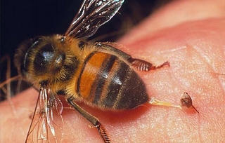 Bị ong đốt bại não