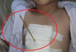 Bé 7 tuổi bị que xiên cá viên chiên đâm thấu ngực