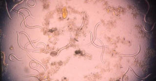 Giun lươn 'đi lạc' làm ổ ở đùi và màng phổi cụ ông 73 tuổi