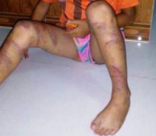 Bảo vệ bé gái 8 tuổi nghi bị bố đẻ đánh đập dã man