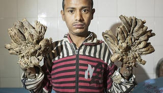 Chàng trai mọc "rễ cây" trên người