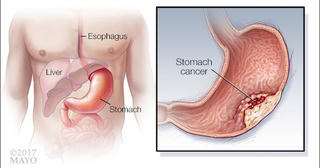 Đừng bỏ qua dấu hiệu của những bệnh ung thư thường gặp