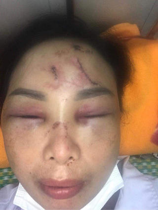 Hải Dương: Vợ 'tố' chồng dùng cực hình tra tấn phải nhập viện