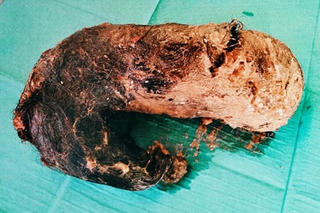 Búi tóc nặng 1,4 kg trong bụng cô gái trẻ