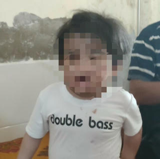 Hà Tĩnh: Bé gái 4 tuổi nhập viện nghi bị bạo hành