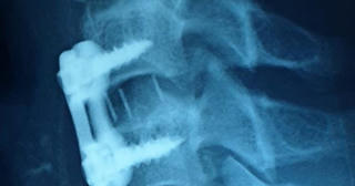 Bị trật đốt sống cổ vì đánh bóng bằng 'đầu'