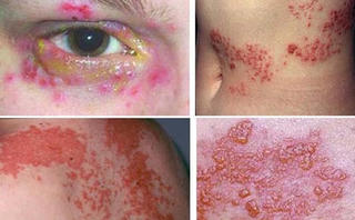 Sốt mò nguy hiểm tính mạng