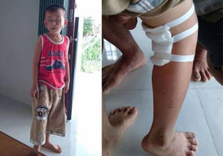 Sẽ kỷ luật bác sĩ mổ 'nhầm' chân bệnh nhi