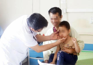 Bé trai 5 tuổi mọc ria mép do lạm dụng corticoid