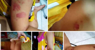 Một bé gái 21 tháng tuổi nghi bị cắn nhiều vết khi đến lớp