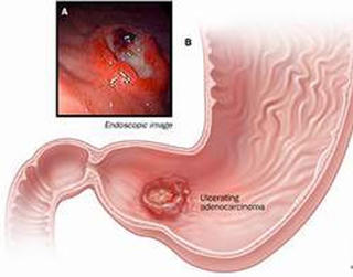 Viêm loét dạ dày nguy hiểm như thế nào?