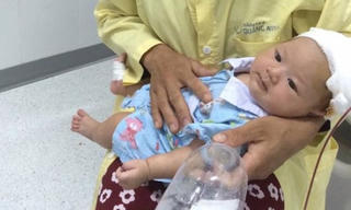 Bé 35 ngày tuổi bị dao quắm xuyên trán đã tự thở, tự bú