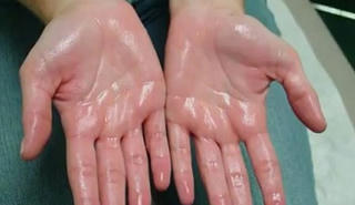 Bệnh đổ mồ hôi chân, tay trong những ngày lạnh: Cách điều trị hiệu qủa tại nhà