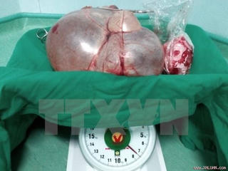 Cắt bỏ thành công khối u xơ tử cung nặng 7,8kg