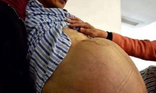 Người đàn ông mang khối u nặng gần 31 kg