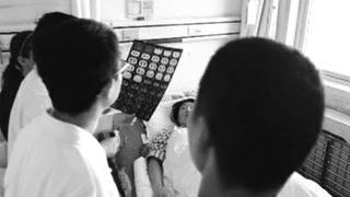 Ớt dài 3 cm chui vào phổi suốt 6 năm mà không biết