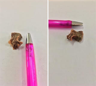 Nội soi gắp xương heo trong thực quản nữ bệnh nhân U60