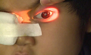 Nguy cơ đục thủy tinh thể suốt đời do lạm dụng thuốc corticoid