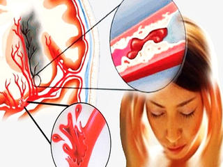 Trời lạnh, đề phòng đột quỵ