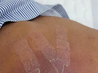 Trẻ 5 tuổi bị hoại tử da vùng bụng do dán cao trị mụn