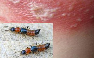 Viêm da mùa mưa lũ