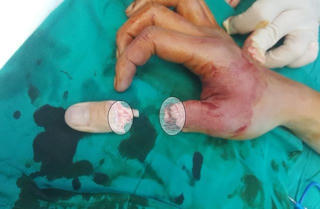 Dây cáp điện thoại rơi xuống cắt lìa ngón tay người đi đường