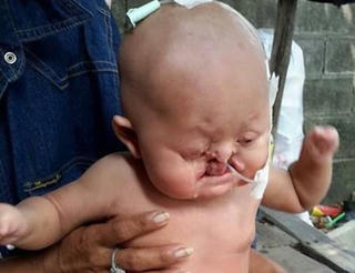 Đau lòng em bé mắc hội chứng người cá