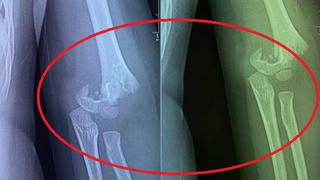 Hà Nội yêu cầu xác minh vụ trẻ mầm non bị ngã gãy tay tại trường