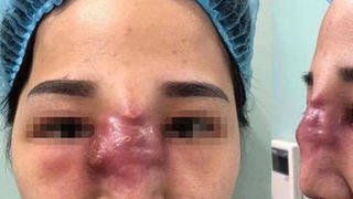 Biến chứng khi làm đẹp tại các cơ sở ‘chui’