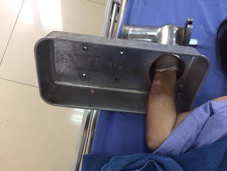 Cấp cứu bệnh nhân tổn thương tay do máy xay thịt