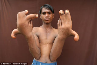 Cậu bé có 'bàn tay của quỷ'