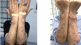 Không mất cảnh giác với bệnh phong