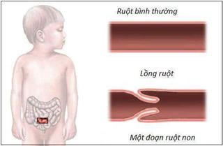 Cảnh báo lồng ruột ở trẻ em mới hơn 5 tháng tuổi