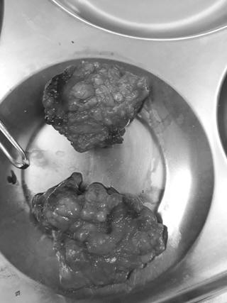 Mắc bệnh lạ, khối u khủng do uống rượu nhiều năm