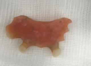 Nội soi cấp cứu lấy cung răng giả trong thực quản bệnh nhân