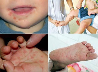Khuyến cáo bệnh tay chân miệng