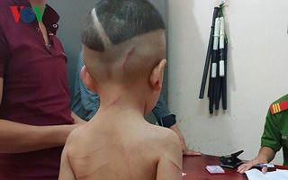 Bắt giam cha dượng hành hung dã man bé 3 tuổi