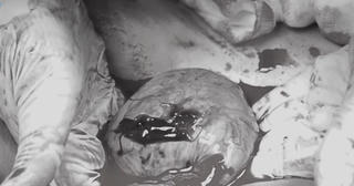 Đã đặt vòng nhưng vẫn mang thai bất thường