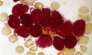 “Cải tạo” tế bào để chữa bệnh ung thư