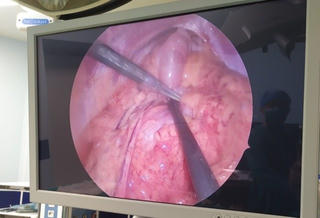 Ruột non 'chui lên' khoang màng phổi của bé 9 tuổi