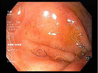 Hàng trăm con giun tóc 'ký sinh' trong tá tràng cụ ông 86 tuổi 