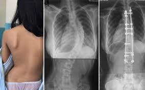 Khám, tư vấn miễn phí cho bệnh nhân có bệnh lý cột sống