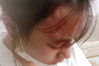 Đi mua kim khâu, nữ sinh bất ngờ bị đánh thương tật 6%