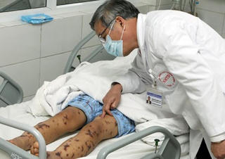 Cảnh giác viêm màng não mô cầu
