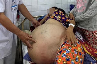 Phẫu thuật thành công khối u nặng 40kg