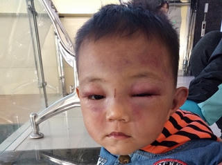 Nghệ An: Không khởi tố bố dượng đánh con riêng của vợ