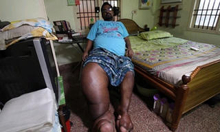 Người đàn ông Ấn Độ có chân phải nặng 100 kg