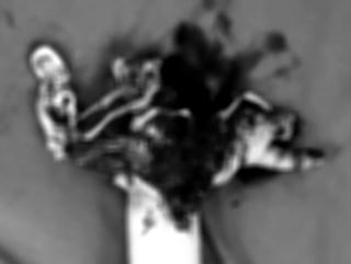 Nam thanh niên bị cắt cụt tay do dùng điện thoại trong lúc sạc