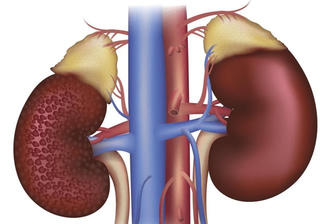 Bệnh thận - biến chứng đáng sợ của đái tháo đường