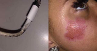 Thiếu nữ bị bỏng mặt vì iPhone bất ngờ phát nổ khi cắm sạc qua đêm